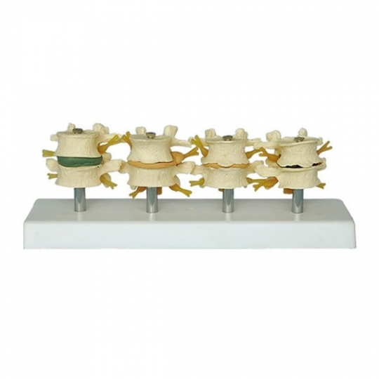 School Lab Stage Degenerative Lumbar Set