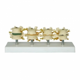 School Lab Stage Degenerative Lumbar Set